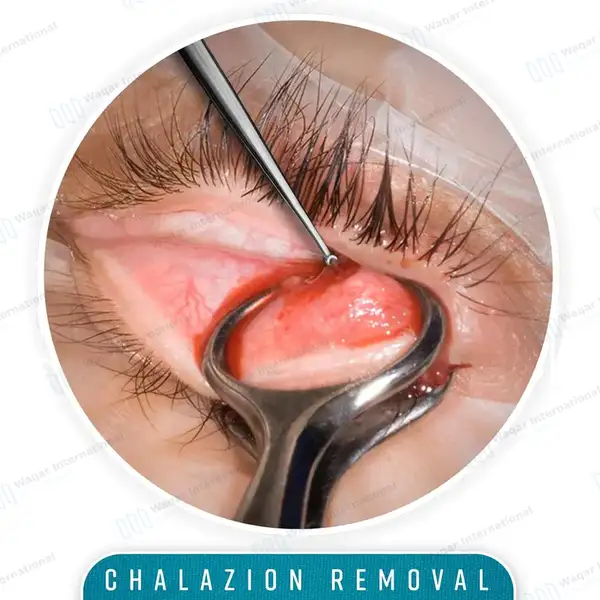 Meyhoefer Chalazion Curette 2.5mm Size #3 Flat Handle 5″ - surgical instruments manufactured by Waqar International, Sialkot - view 7